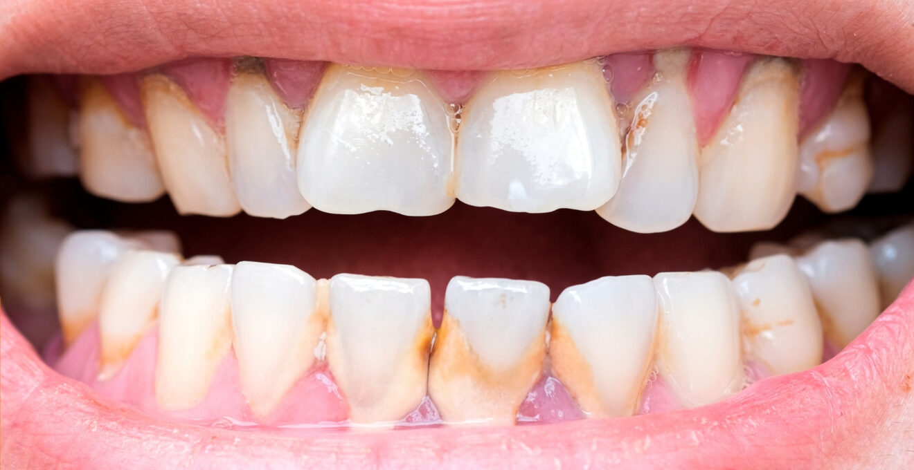 dent qui se déchausse.jpg