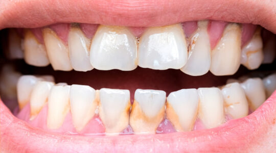 dent qui se déchausse.jpg